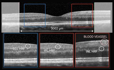 Hyper-reflective foci changes in RRMS under natalizumab therapy